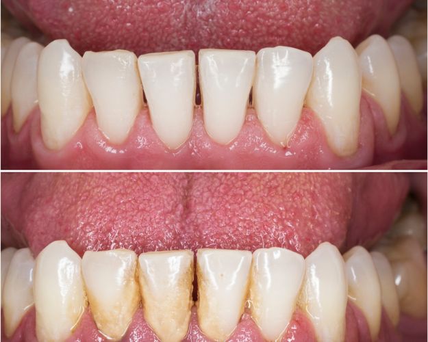 dientes limpios antes y despues